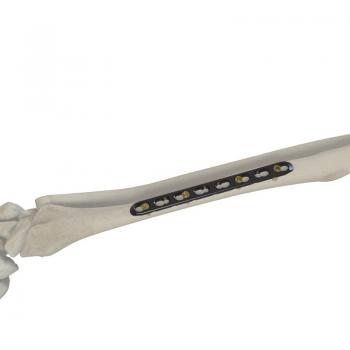 尺、橈骨鎖定接骨板