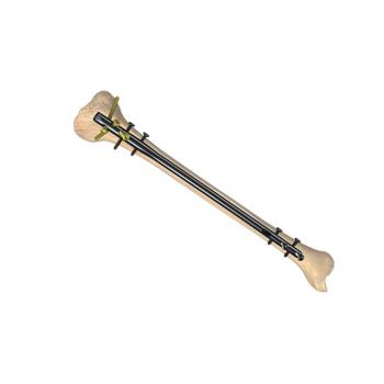 脛骨髓內(nèi)釘（X系列專(zhuān)家級(jí)）